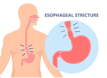 Esophageul stricture dilation
