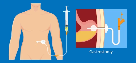 P-E-G tube insertion