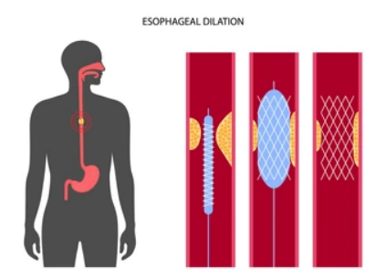 Oesophageal Metal Stenting