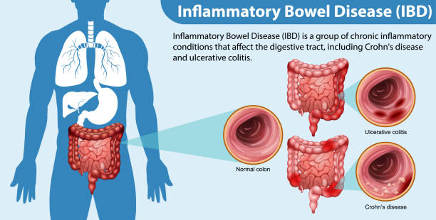 Liver Cirrhosis Treatment in Pune