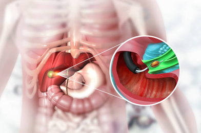 Procedure of ERCP