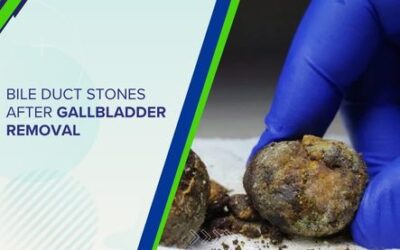 Bile Duct Stones After Gallbladder Removal
