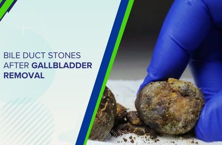 Bile Duct Stones After Gallbladder Removal