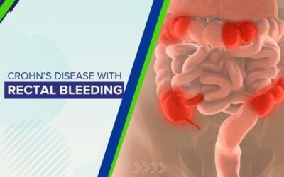 Crohn’s Disease with Rectal Bleeding
