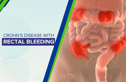 Crohn’s Disease with Rectal Bleeding