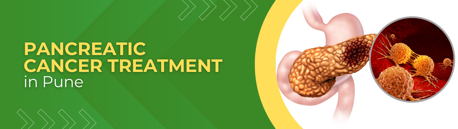 Pancreatic Cancer Treatment