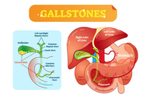 Bile Duct Stones After Gallbladder Removal | Dr. Ksheetij Kothari