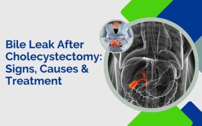 Bile Leak After Cholecystectomy – Causes, Symptoms & Treatments