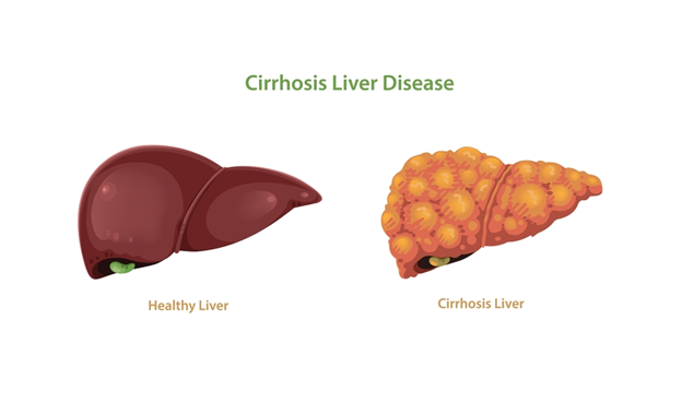 Stage 3 Liver Cirrhosis: Understanding the Condition