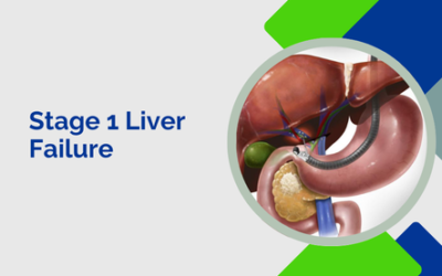 Stage 1 Liver Failure