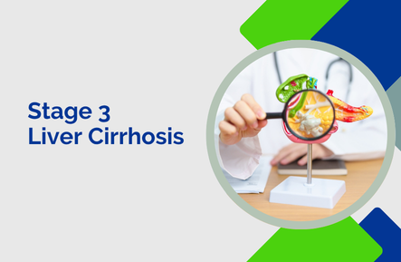 Stage 3 Liver Cirrhosis: Understanding the Condition