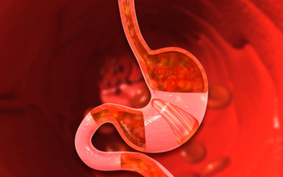 Thinning of the Stomach Lining