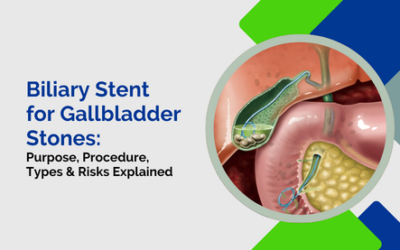 Biliary Stent for Gallbladder Stones: Purpose, Procedure, Types & Risks Explained