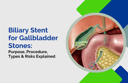 Biliary Stent for Gallbladder Stones: Purpose, Procedure, Types & Risks Explained