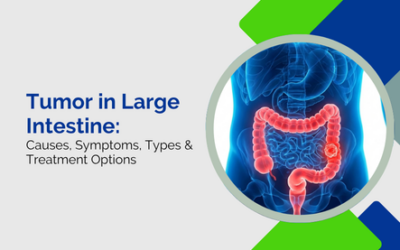 Tumor in Large Intestine: Causes, Symptoms, Types & Treatment Options