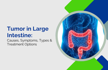 Tumor in Large Intestine: Causes, Symptoms, Types & Treatment Options