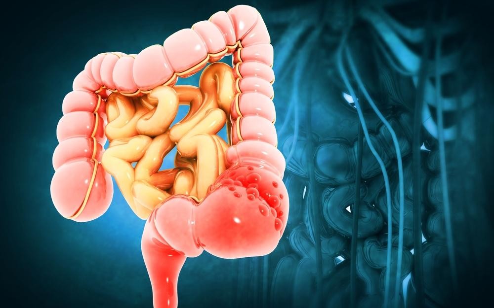 Illustration of the human large intestine with diverticula highlighted in pink against a blue background.