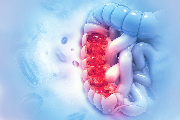 3D illustration of the large intestine with a highlighted inflamed red section indicating disease.