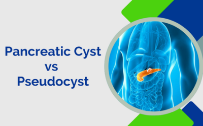Pancreatic Cyst vs Pseudocyst: What’s the Difference?