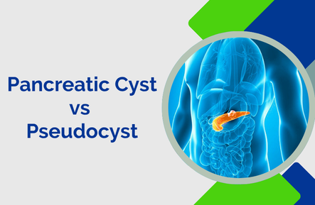 Pancreatic Cyst vs Pseudocyst: What’s the Difference?