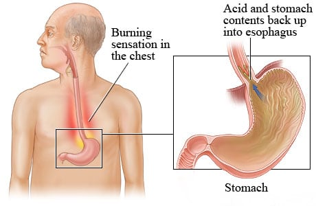 Diagram showing heartburn: a man with a highlighted stomach and esophagus indicating acid reflux causing chest burning.