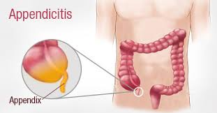 Educational diagram of the digestive system showing an inflamed appendix (appendicitis) with a zoomed-in view of the appendix.