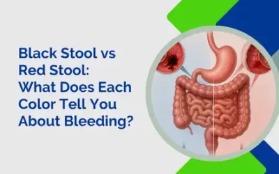 Black Stool vs Red Stool: What Does Each Color Tell You About Bleeding?