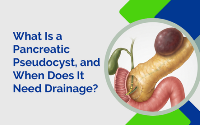 What Is a Pancreatic Pseudocyst, and When Does It Need Drainage?