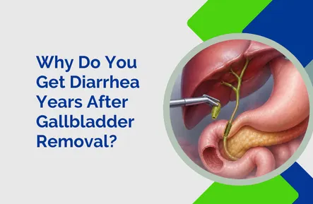 Why Do You Get Diarrhea Years After Gallbladder Removal
