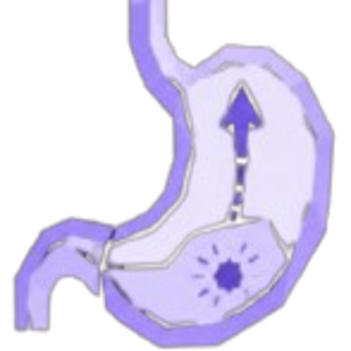 Stylized purple diagram of a stomach with a vertical arrow showing upward movement in the tube added to the organ.