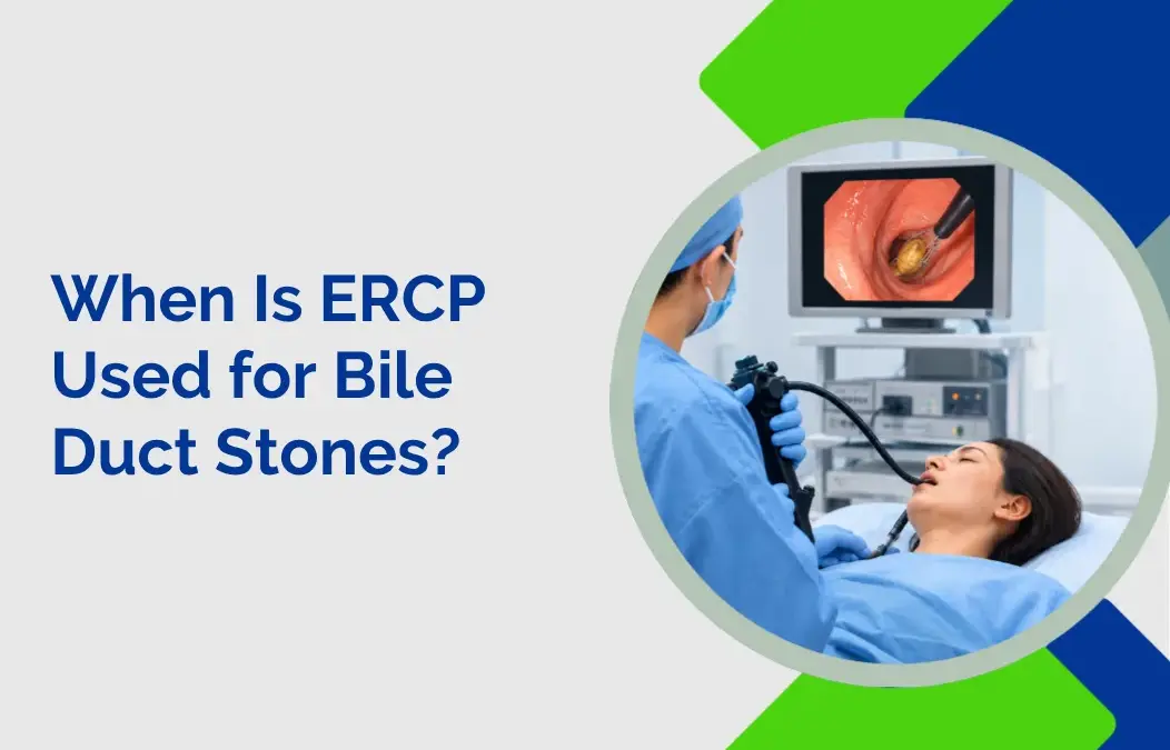 When Is ERCP Used for Bile Duct Stones