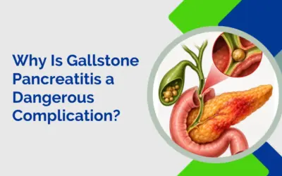 Why Is Gallstone Pancreatitis a Dangerous Complication?